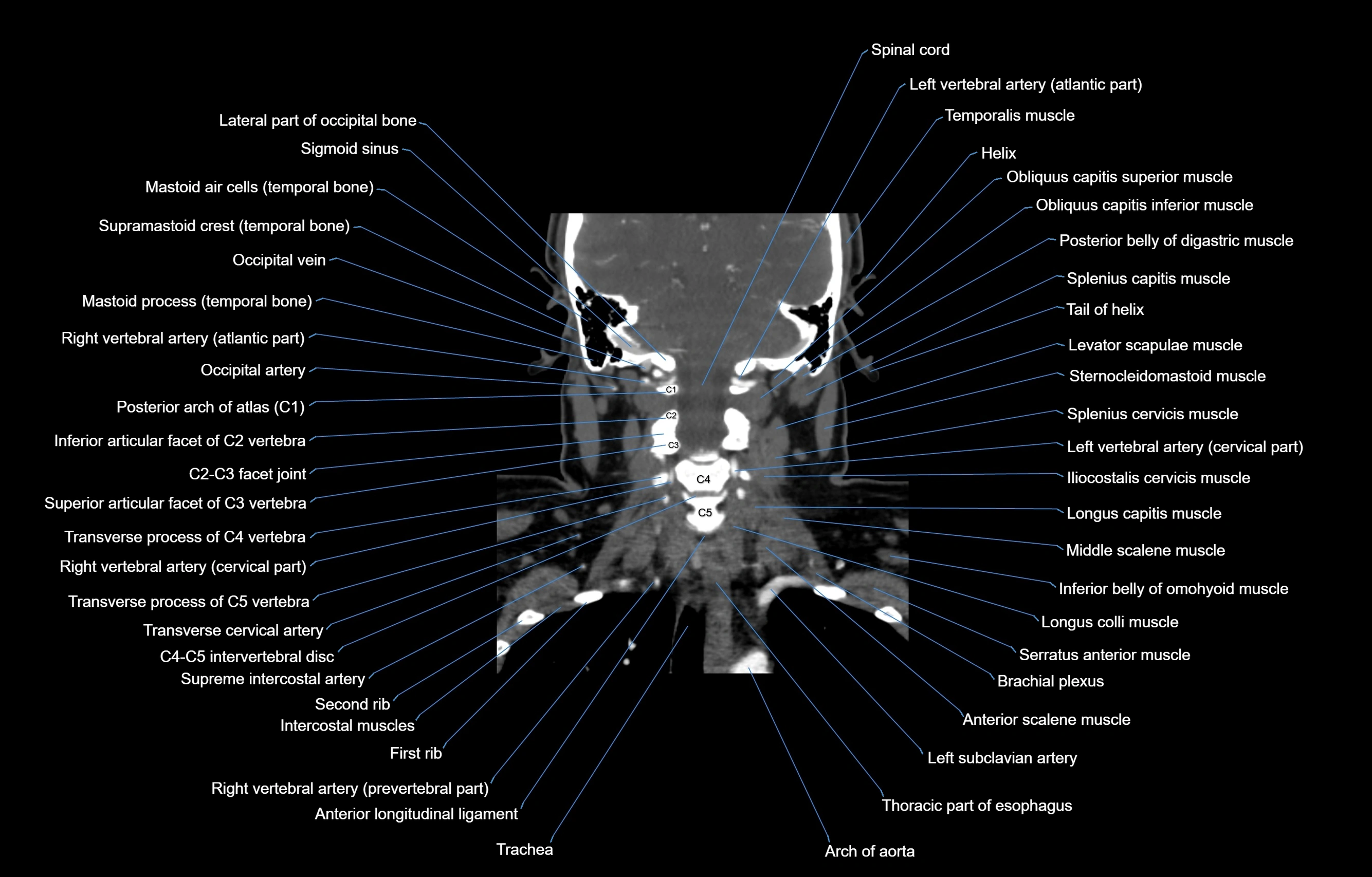 CT Neck coronal  cross sectional anatomy labelled 3D  radiology  image-00043.webp